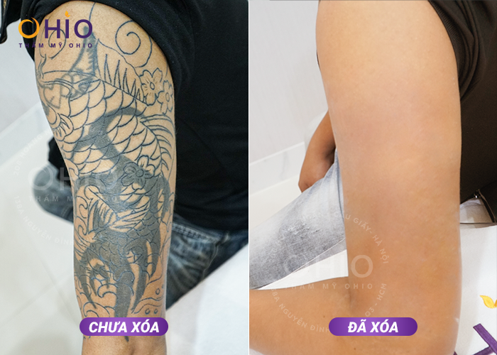 Anh Trung Kiên: Tôi đã xóa sạch hình xăm lâu năm tại OHIO! - Phòng khám da liễu OHIO Anh Trung Kiên: Tôi đã xóa sạch hình xăm lâu năm tại OHIO!