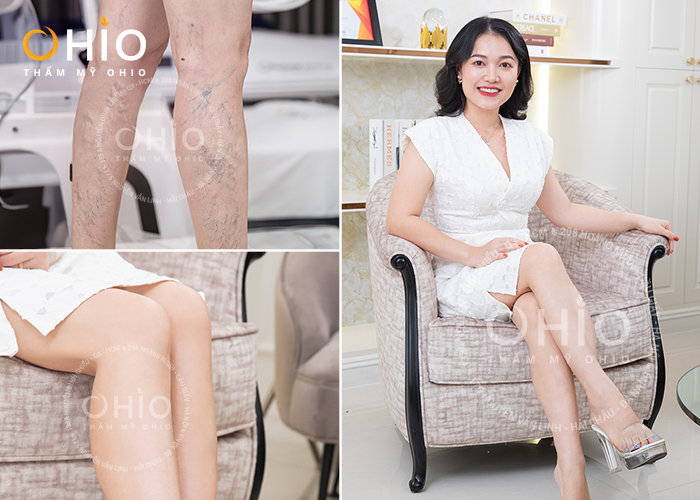 Chị Minh Hoa: Cảm ơn OHIO đã giúp tôi điều trị giãn mao mạch chân