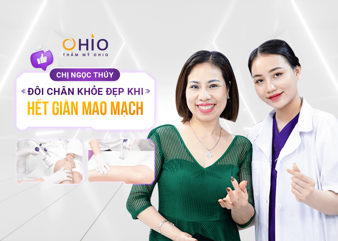 Chị Ngọc Thúy: Đôi chân khỏe đẹp - khi hết giãn mao mạch - Phòng khám da liễu OHIO điều trị giãn mao mạch chân