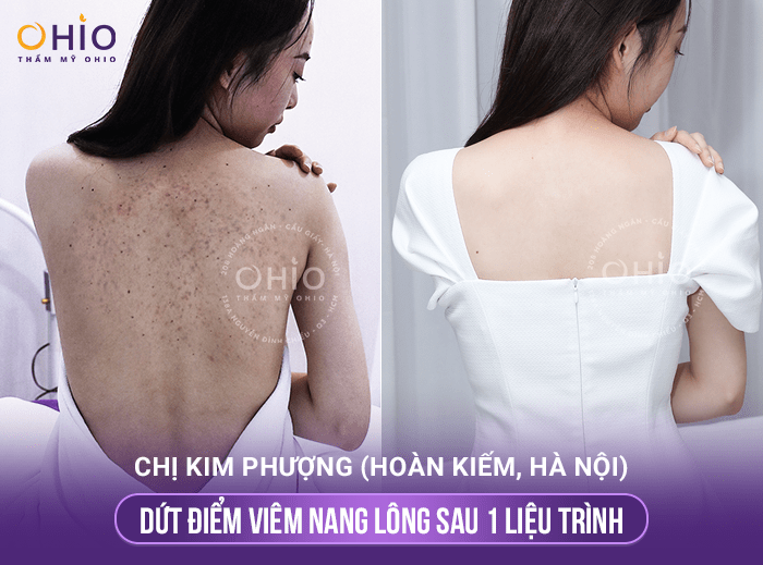 Phòng khám OHIO đơn vị chuyển giao độc quyền công nghệ trị viêm nang lông Matrixlight - Phòng khám da liễu OHIO Phòng khám OHIO đơn vị chuyển giao độc quyền công nghệ trị viêm nang lông Matrixlight