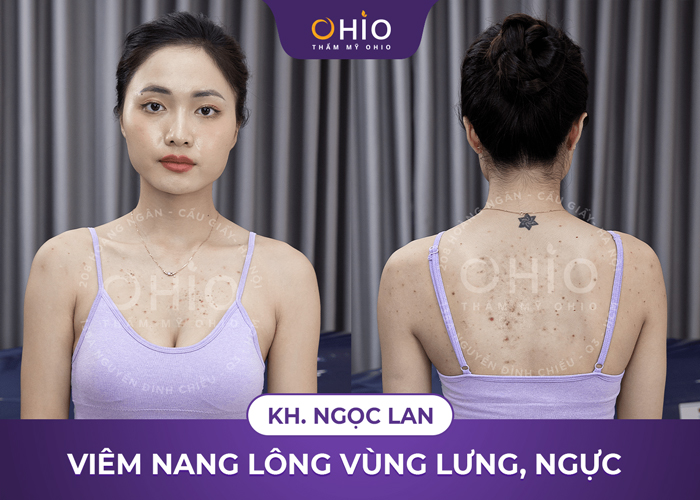 Chị Ngọc Lan: Dứt điểm bệnh viêm nang lông nhờ Matrixlight - Phòng khám da liễu OHIO viêm nang lông