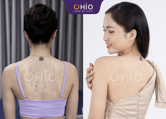 Chị Ngọc Lan: Dứt điểm bệnh viêm nang lông nhờ Matrixlight - Phòng khám da liễu OHIO Chị Ngọc Lan: Dứt điểm bệnh viêm nang lông nhờ Matrixlight