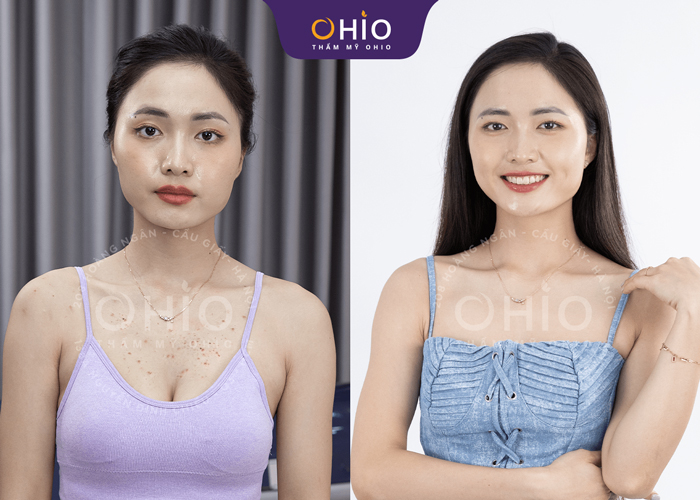 Chị Ngọc Lan: Dứt điểm bệnh viêm nang lông nhờ Matrixlight - Phòng khám da liễu OHIO Chị Ngọc Lan: Dứt điểm bệnh viêm nang lông nhờ Matrixlight