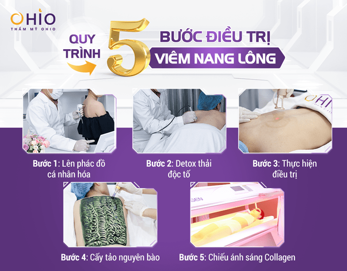 Phòng khám OHIO đơn vị chuyển giao độc quyền công nghệ trị viêm nang lông Matrixlight - Phòng khám da liễu OHIO Phòng khám OHIO đơn vị chuyển giao độc quyền công nghệ trị viêm nang lông Matrixlight