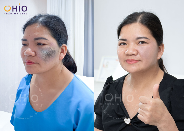 Chị Sự (Hà Nội): Xóa sạch chàm đen lấy lại tự tin sau 50 năm