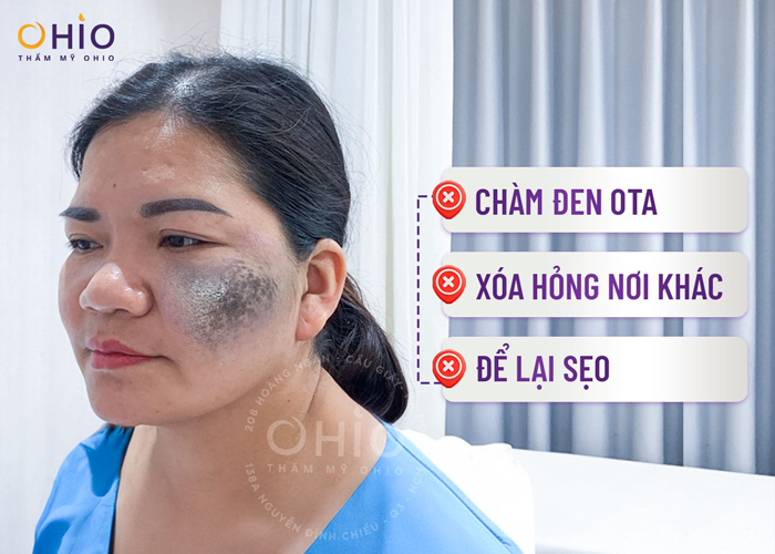 Chị Sự (Hà Nội): Xóa sạch chàm đen lấy lại tự tin sau 50 năm