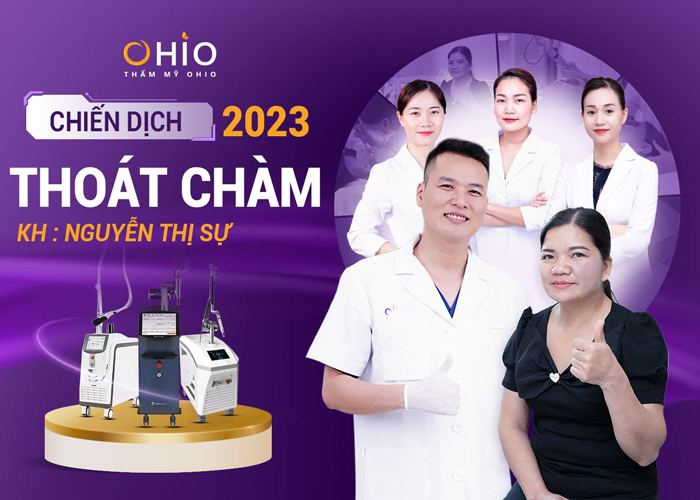 xóa sạch chàm đen