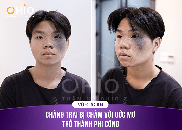 Đức An: Chàng trai với ước mơ trở thành phi công bị vết chàm che lấp - Phòng khám da liễu OHIO vết bớt đen bẩm sinh
