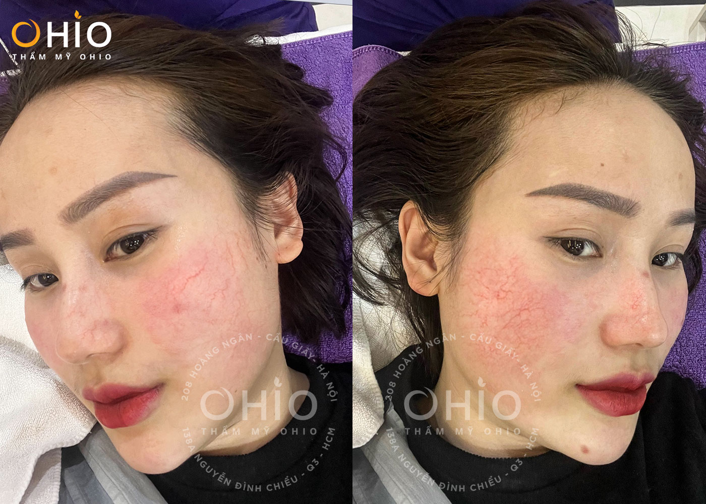 Chị Nguyễn Thủy: Thay đổi ngỡ ngàng sau điều trị giãn mao mạch tại OHIO - Phòng khám da liễu OHIO xuất hiện giãn mao mạch trên mặt