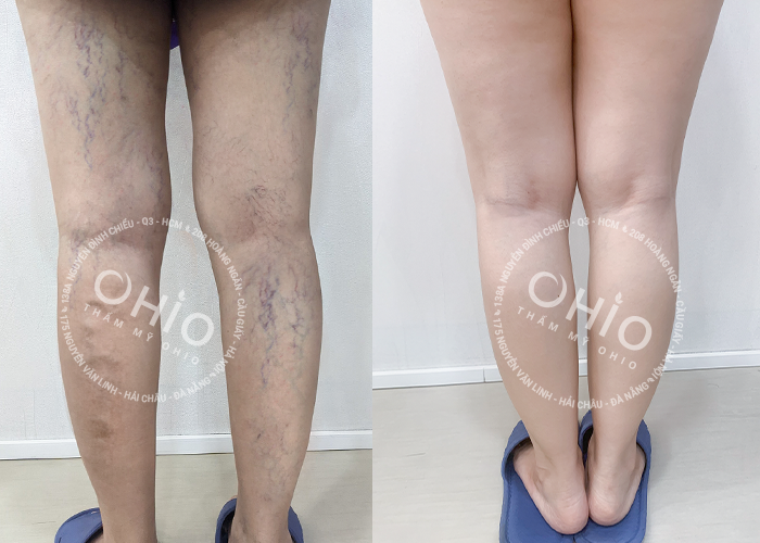 Chị Ngọc Lan - Cảm ơn OHIO đã giúp tôi lấy lại đôi chân đẹp xinh như xưa - Phòng khám da liễu OHIO Chị Ngọc Lan - Cảm ơn OHIO đã giúp tôi lấy lại đôi chân đẹp xinh như xưa