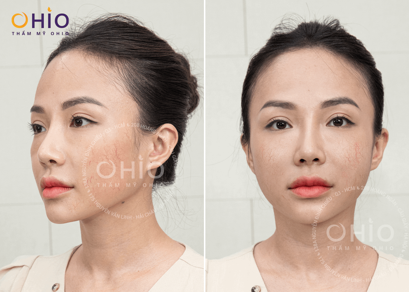 Hot Mom Huyền Trang: Tự tin làm mẫu ảnh khi hết giãn mao mạch - Phòng khám da liễu OHIO tình trạng giãn mao mạch vùng mặt