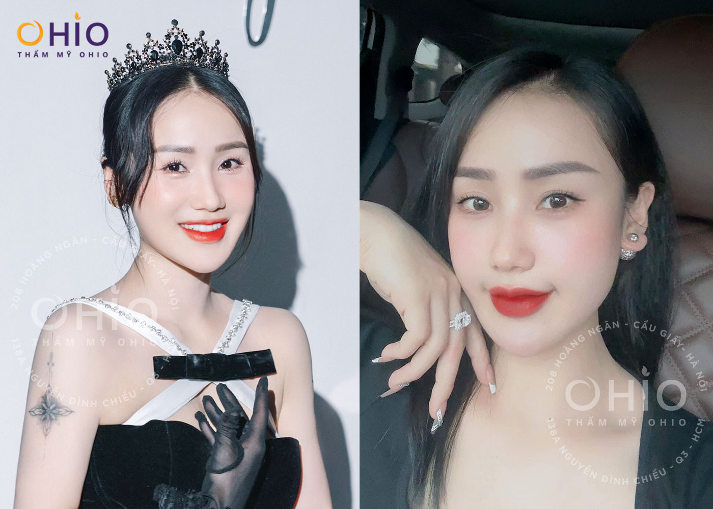 Chị Nguyễn Thủy: Thay đổi ngỡ ngàng sau điều trị giãn mao mạch tại OHIO - Phòng khám da liễu OHIO Chị Nguyễn Thủy: Thay đổi ngỡ ngàng sau điều trị giãn mao mạch tại OHIO