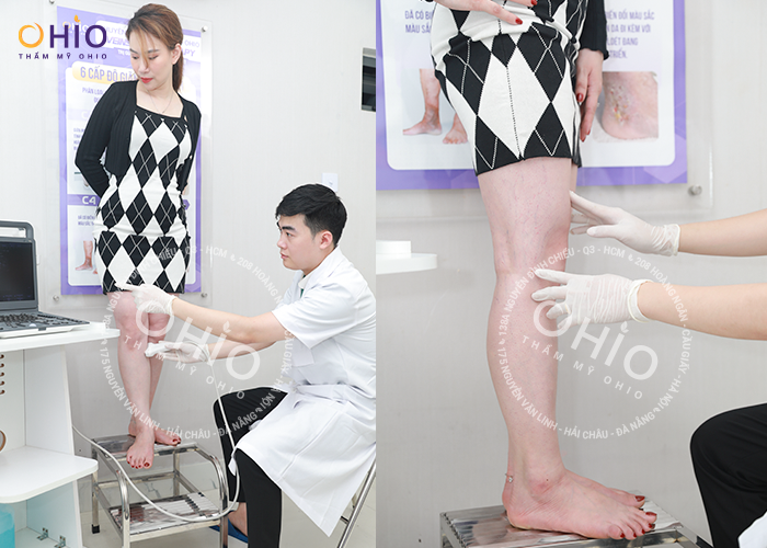Chị Ngọc Lan - Cảm ơn OHIO đã giúp tôi lấy lại đôi chân đẹp xinh như xưa - Phòng khám da liễu OHIO Chị Ngọc Lan - Cảm ơn OHIO đã giúp tôi lấy lại đôi chân đẹp xinh như xưa