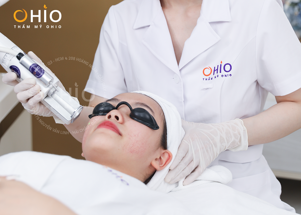 Thẩm mỹ OHIO đã giúp tôi xóa sạch Giãn mao mạch mặt! - Phòng khám da liễu OHIO Thẩm mỹ OHIO đã giúp tôi xóa sạch Giãn mao mạch mặt!