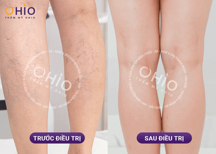 Giãn mao mạch chân 7 năm và “liều thuốc” cứu cánh - Phòng khám da liễu OHIO Giãn mao mạch chân 7 năm và “liều thuốc” cứu cánh