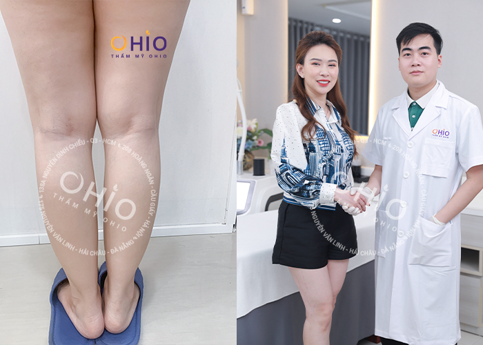 Chị Ngọc Lan - Cảm ơn OHIO đã giúp tôi lấy lại đôi chân đẹp xinh như xưa - Phòng khám da liễu OHIO Chị Ngọc Lan - Cảm ơn OHIO đã giúp tôi lấy lại đôi chân đẹp xinh như xưa