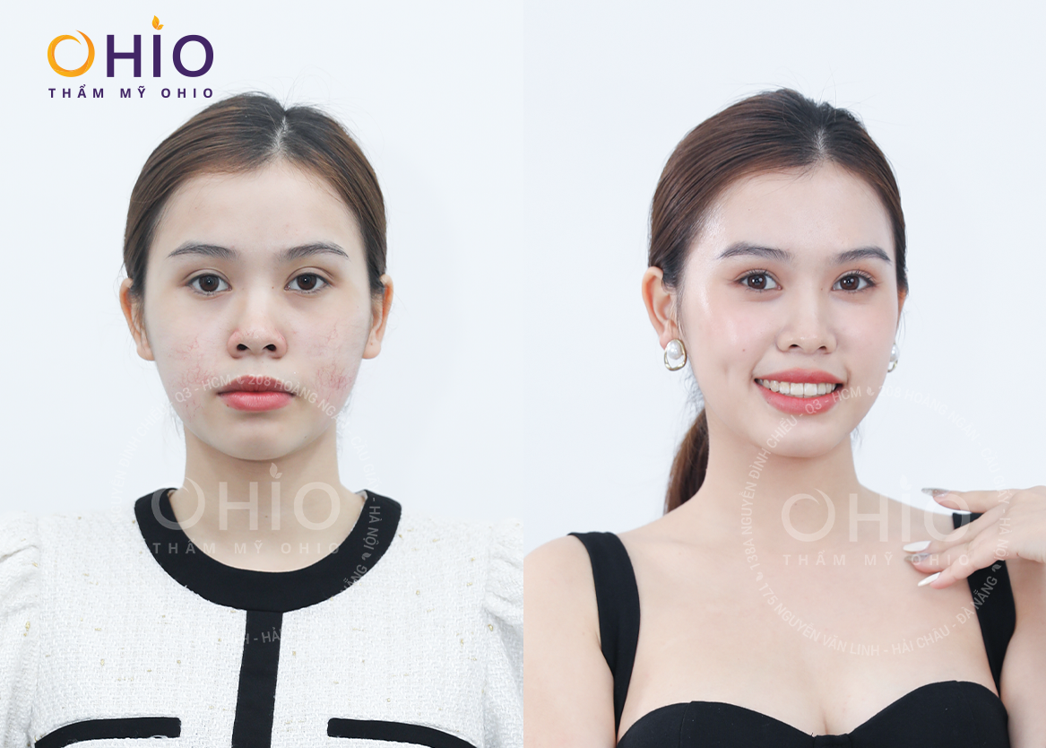 Thẩm mỹ OHIO đã giúp tôi xóa sạch Giãn mao mạch mặt!