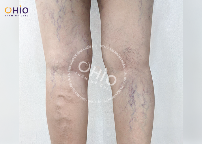 Chị Ngọc Lan - Cảm ơn OHIO đã giúp tôi lấy lại đôi chân đẹp xinh như xưa - Phòng khám da liễu OHIO vết giãn mao mạch chân