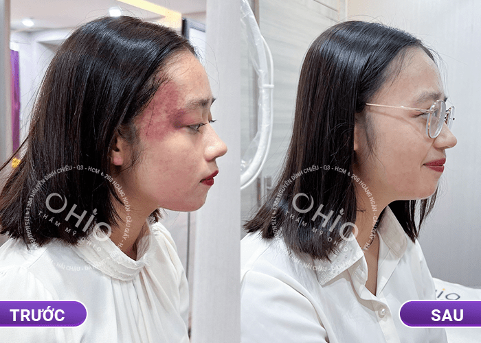 Bùi Trang: Tôi tự tin đứng trên bục giảng nhờ xóa bớt rượu vang tại OHIO - Phòng khám da liễu OHIO Bùi Trang: Tôi tự tin đứng trên bục giảng nhờ xóa bớt rượu vang tại OHIO