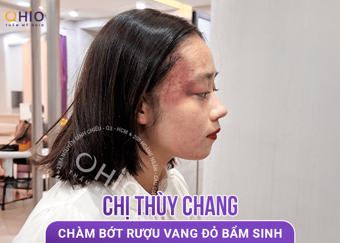 Bùi Trang: Tôi tự tin đứng trên bục giảng nhờ xóa bớt rượu vang tại OHIO - Phòng khám da liễu OHIO xoá chàm bớt rượu vang đỏ