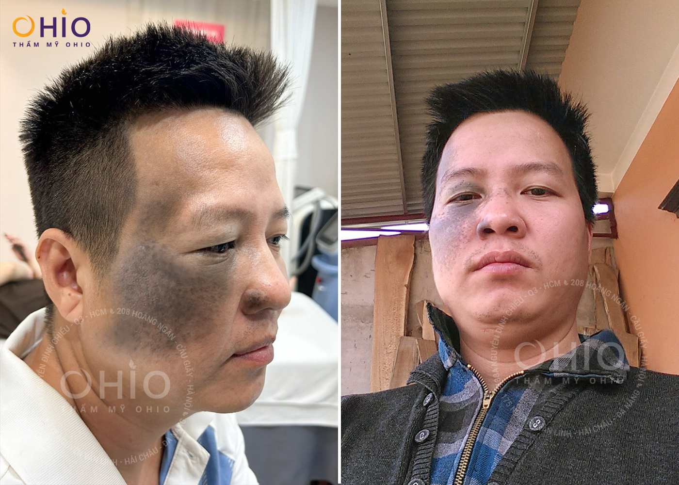 Anh Đức Đại - Sạch bớt OTA bẩm sinh, tự tin làm lại cuộc đời - Phòng khám da liễu OHIO vết chàm bớt OTA bẩm sinh