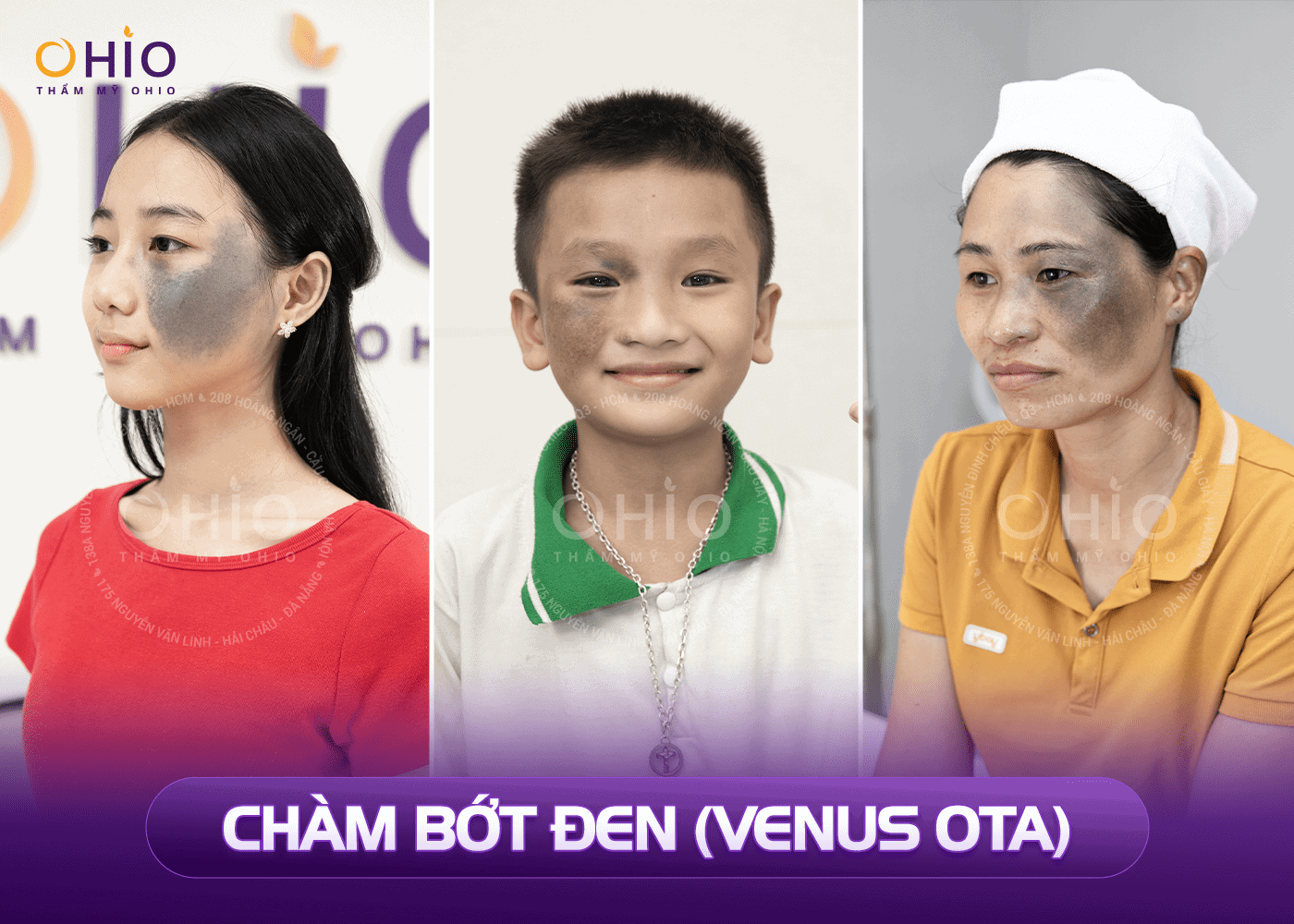 Chàm bớt OTA và 4 điều bạn cần biết ! - Phòng khám da liễu OHIO Chàm bớt OTA