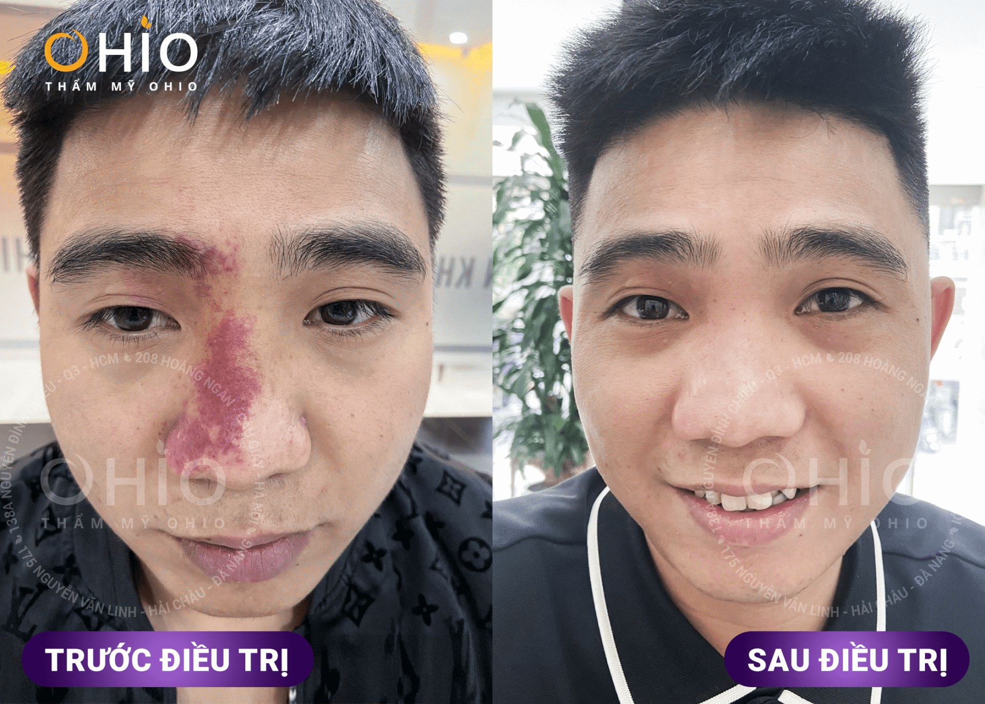 bớt đỏ rượu vang