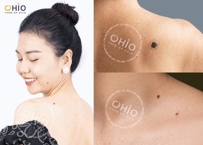 Laser Extra - Xóa sạch nốt ruồi - Phòng khám da liễu OHIO xóa nốt ruồi