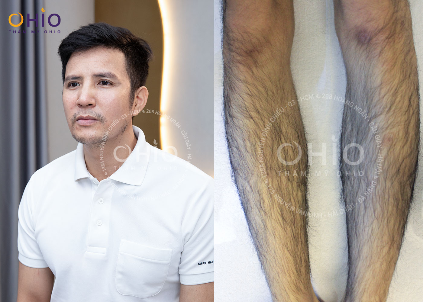 Anh Tống Đức: Triệt sạch lông, râu - Tự tin hơn, phong độ hơn! - Phòng khám da liễu OHIO liệu trình triệt lông