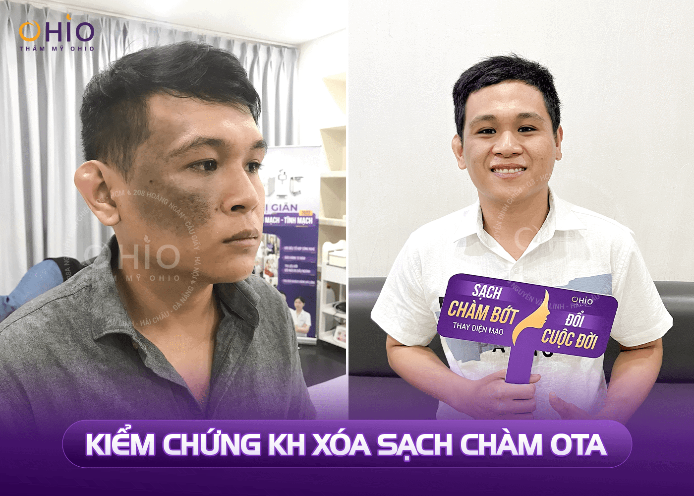 Chàm bớt OTA và 4 điều bạn cần biết ! - Phòng khám da liễu OHIO Chàm bớt OTA và 4 điều bạn cần biết !