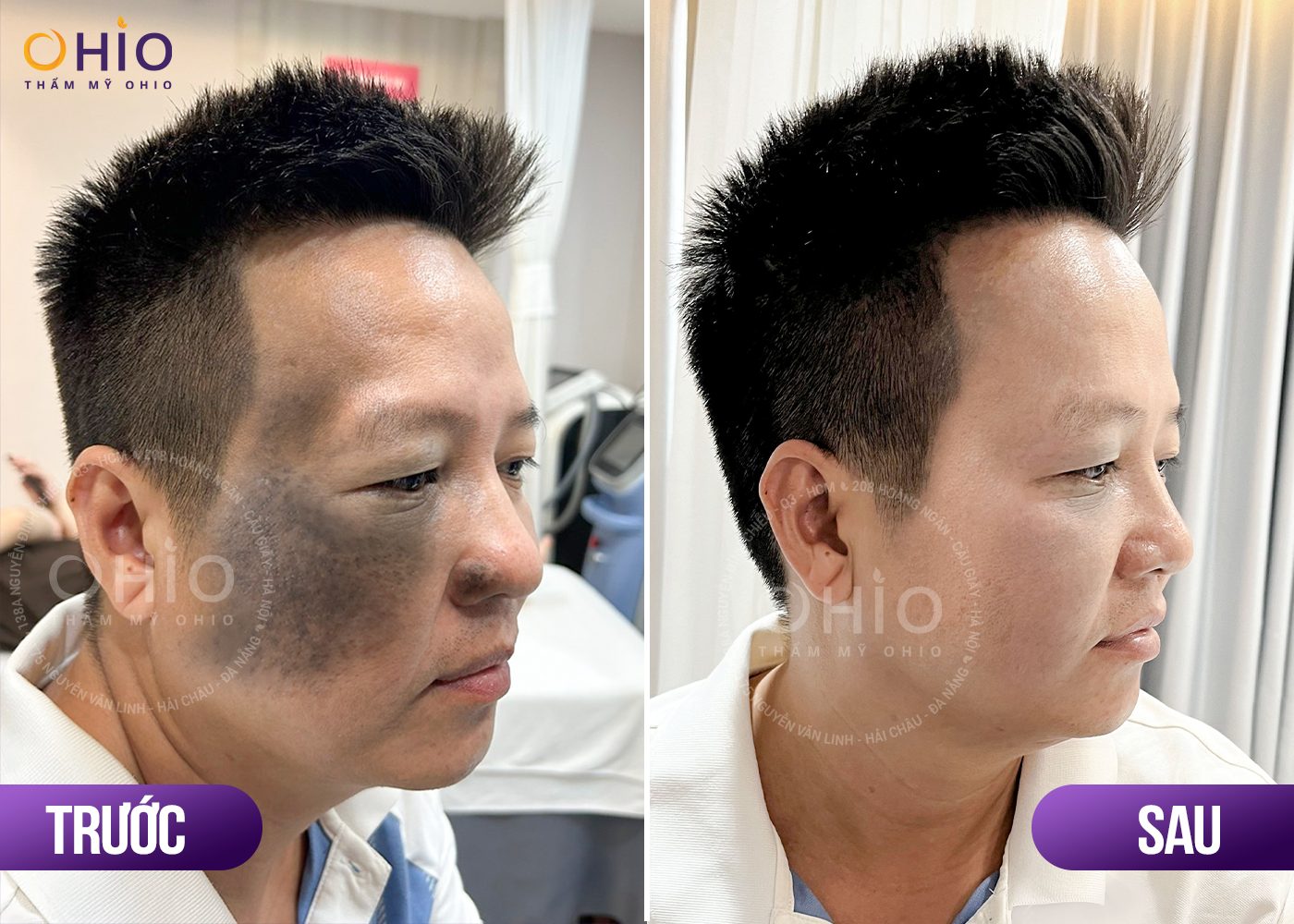 Anh Đức Đại - Sạch bớt OTA bẩm sinh, tự tin làm lại cuộc đời - Phòng khám da liễu OHIO Anh Đức Đại - Sạch bớt OTA bẩm sinh, tự tin làm lại cuộc đời