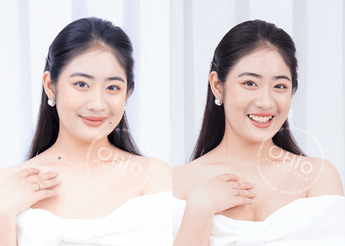 Laser Extra - Xóa sạch nốt ruồi - Phòng khám da liễu OHIO xóa nốt ruồi 6