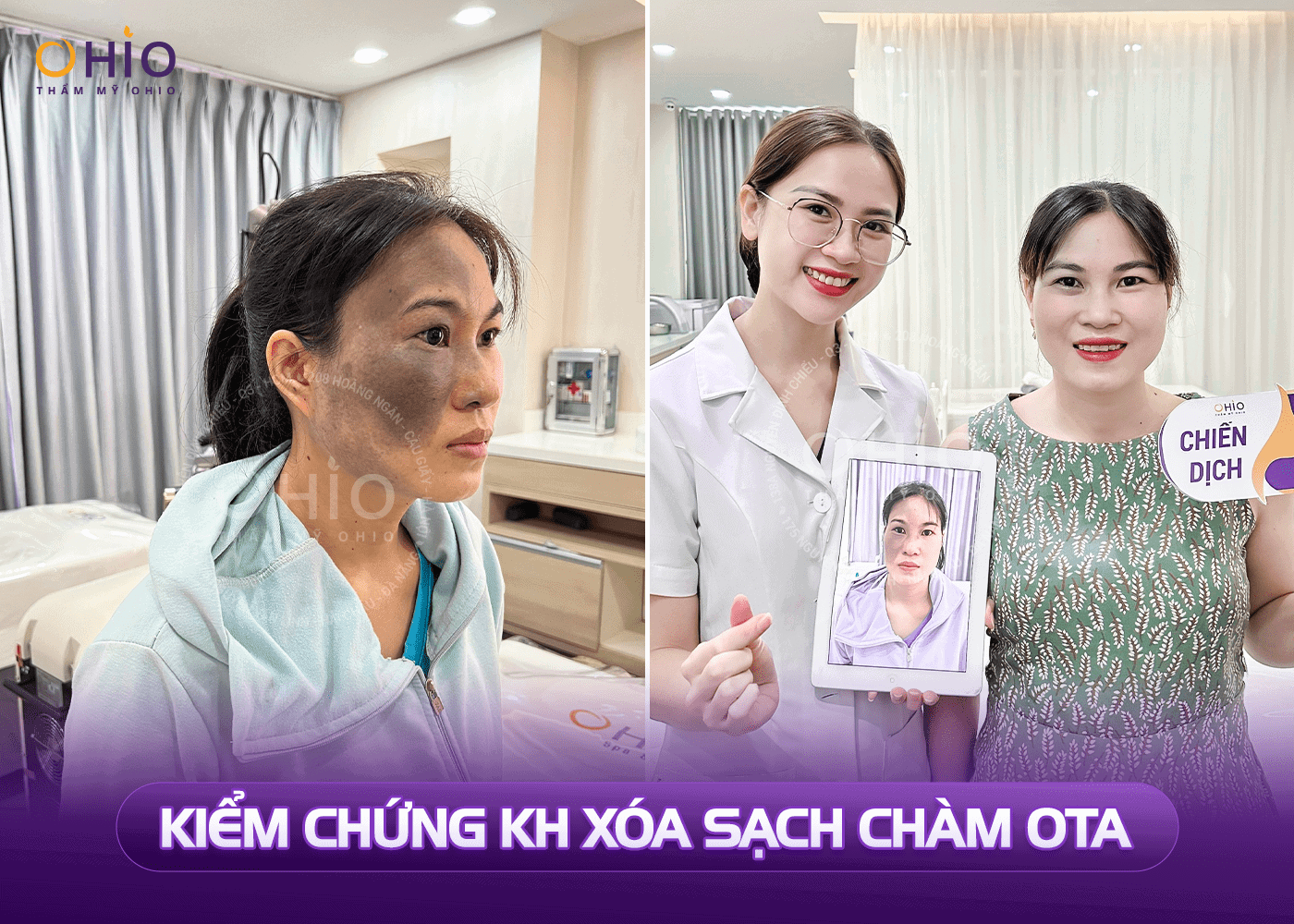 Chàm bớt OTA và 4 điều bạn cần biết ! - Phòng khám da liễu OHIO Chàm bớt OTA và 4 điều bạn cần biết !