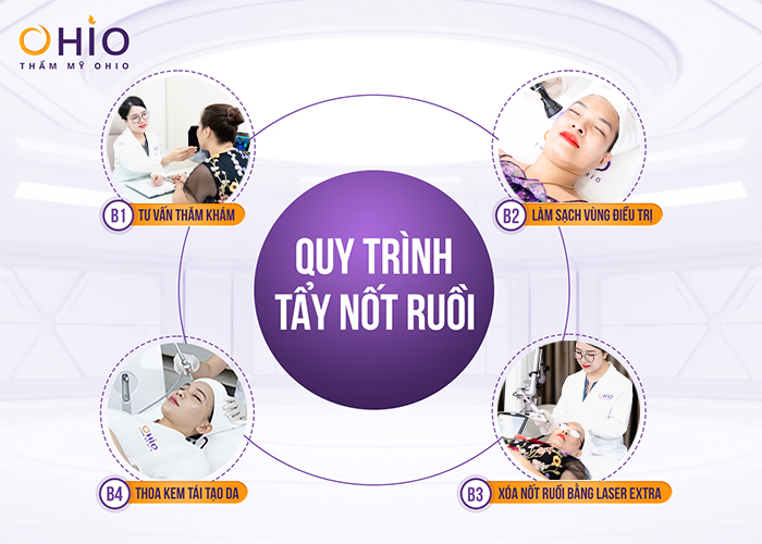 Laser Extra - Xóa sạch nốt ruồi - Phòng khám da liễu OHIO Laser Extra - Xóa sạch nốt ruồi
