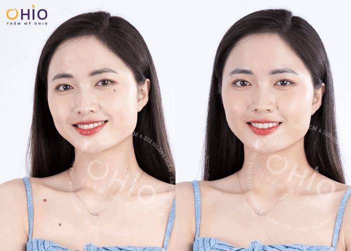 Laser Extra - Xóa sạch nốt ruồi - Phòng khám da liễu OHIO xóa nốt ruồi 4