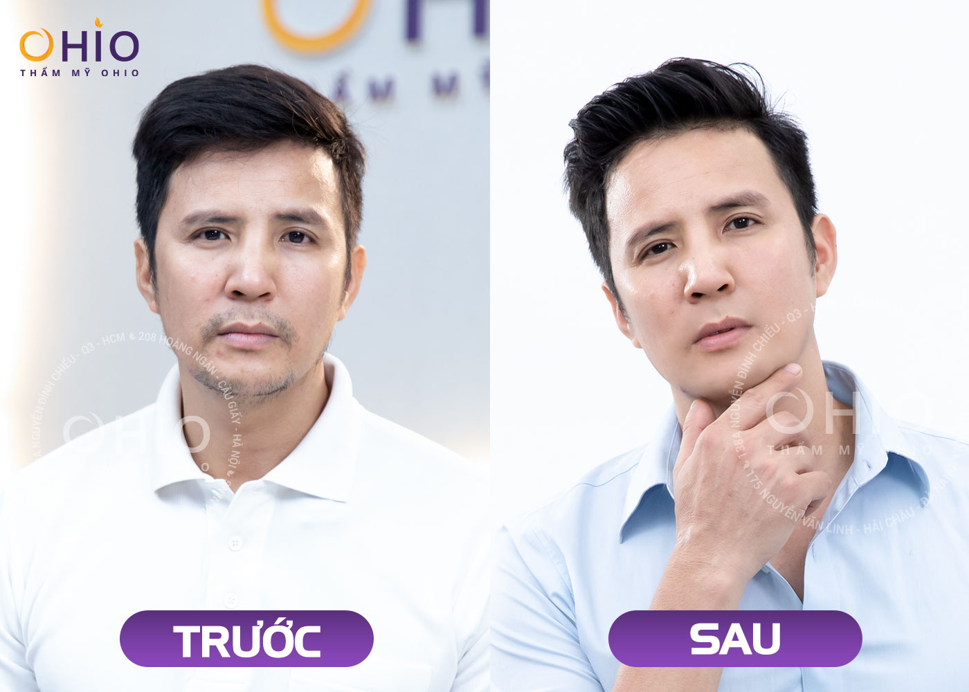 Anh Tống Đức: Triệt sạch lông, râu - Tự tin hơn, phong độ hơn!
