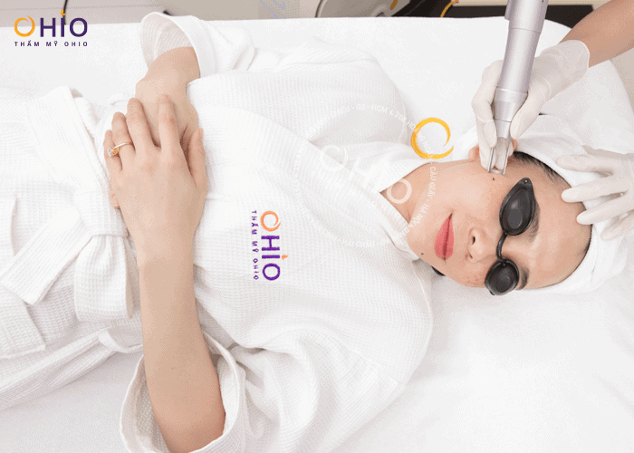 Laser Extra - Xóa sạch nốt ruồi - Phòng khám da liễu OHIO xóa nốt ruồi 3