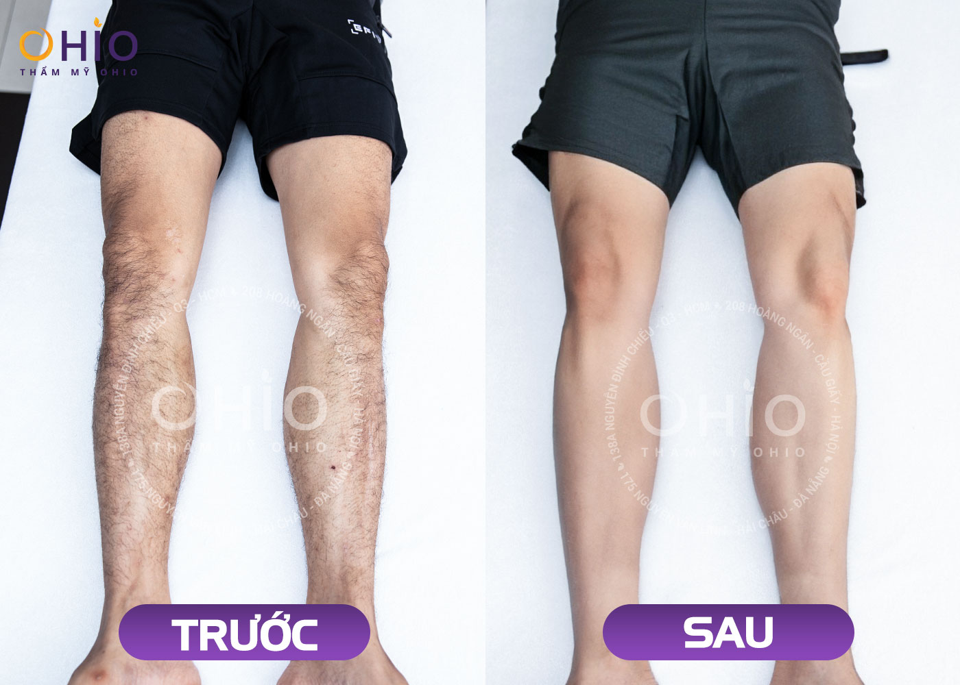 Anh Tống Đức: Triệt sạch lông, râu - Tự tin hơn, phong độ hơn!