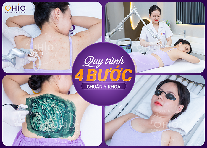 Chị Hoàng Huyền: Hành trình vượt qua nỗi ám ảnh mang tên “Viêm nang lông” - Phòng khám da liễu OHIO Chị Hoàng Huyền: Hành trình vượt qua nỗi ám ảnh mang tên “Viêm nang lông”