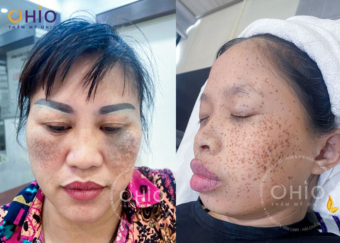 Bớt tăng sinh sắc tố là gì? Nguyên nhân và cách điều trị hiệu quả - Phòng khám da liễu OHIO Bớt tăng sinh sắc tố
