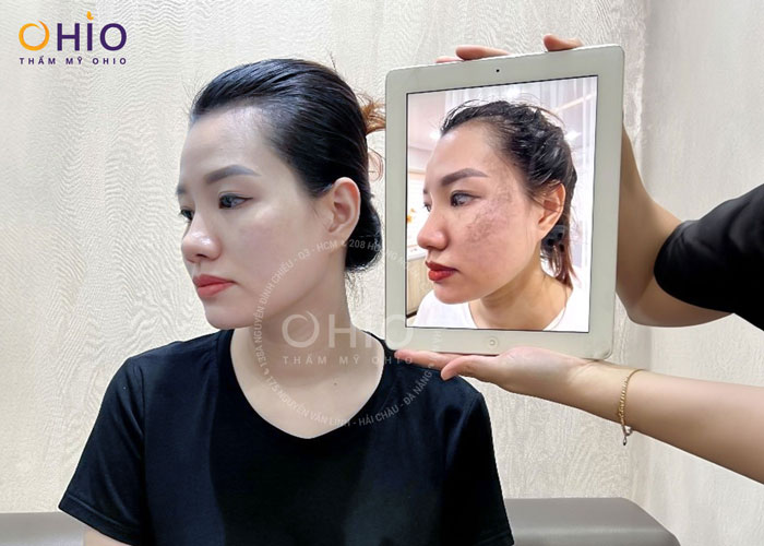 Bớt tăng sinh sắc tố là gì? Nguyên nhân và cách điều trị hiệu quả - Phòng khám da liễu OHIO bớt hori