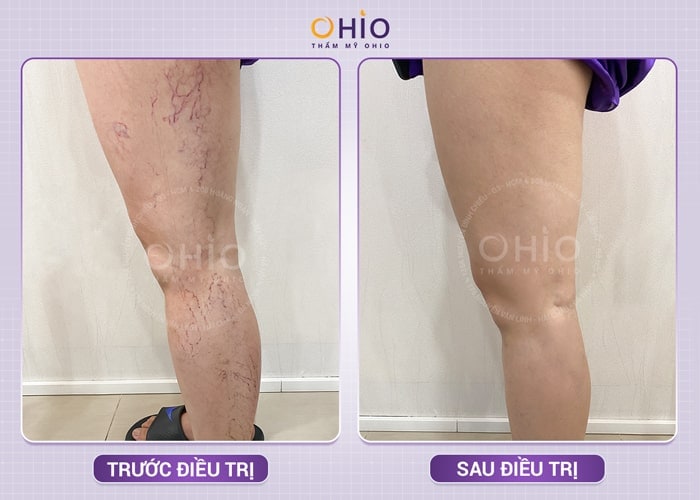 Trị giãn mao mạch hiệu quả với laser xung dài tại Phòng khám chuyên khoa da liễu OHIO