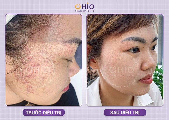 Trị giãn mao mạch hiệu quả với laser xung dài tại Phòng khám chuyên khoa da liễu OHIO