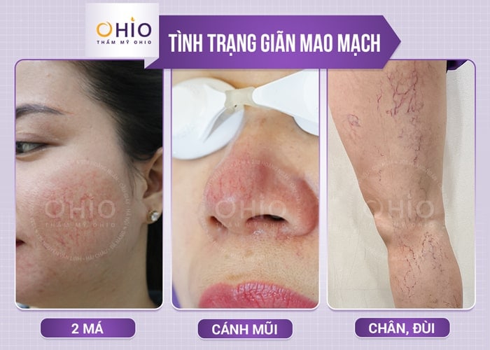 điều trị giãn mao mạch không xâm lấn