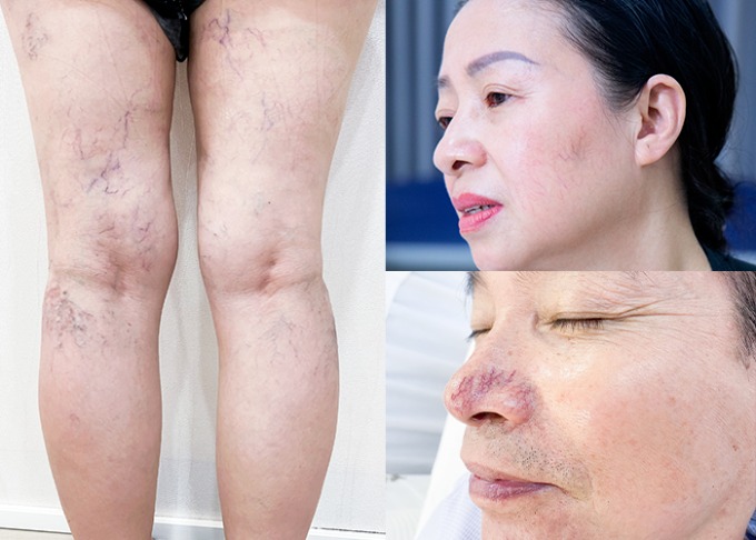 Thẩm mỹ Ohio ứng dụng laser xung dài trị giãn mao mạch - Phòng khám da liễu OHIO trị giãn mao mạch không xâm lấn
