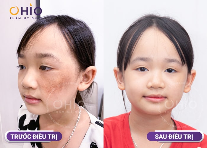 Chàm bớt nâu cà phê là gì? Cách điều trị hiệu quả, an toàn - Phòng khám da liễu OHIO Chàm bớt nâu cà phê là gì? Cách điều trị hiệu quả, an toàn