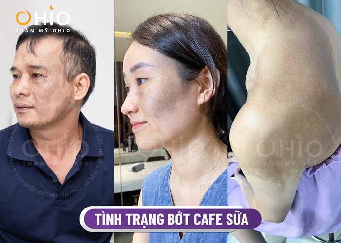 Chàm bớt nâu cà phê là gì? Cách điều trị hiệu quả, an toàn - Phòng khám da liễu OHIO Chàm bớt nâu cà phê