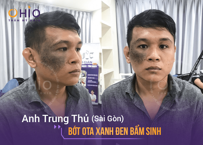 Chàm bớt OTA và 4 điều bạn cần biết ! - Phòng khám da liễu OHIO chàm bớt đen ota