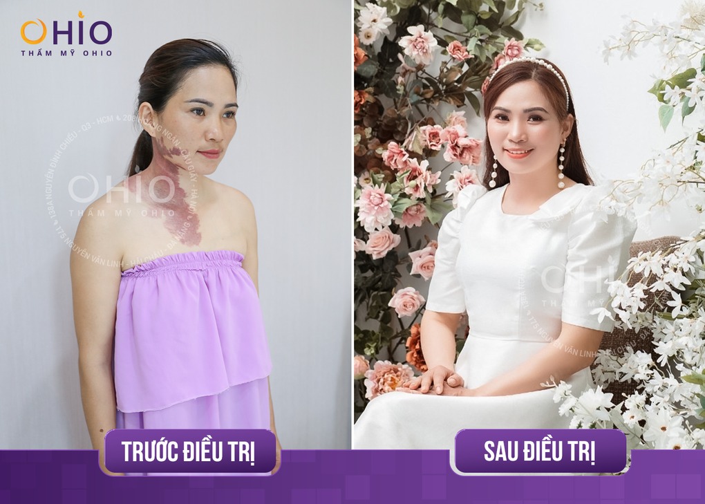 Xóa chàm bớt sắc tố hiệu quả với tổ hợp công nghệ Laser Pico - Phòng khám da liễu OHIO xóa chàm bớt sắc tố 3