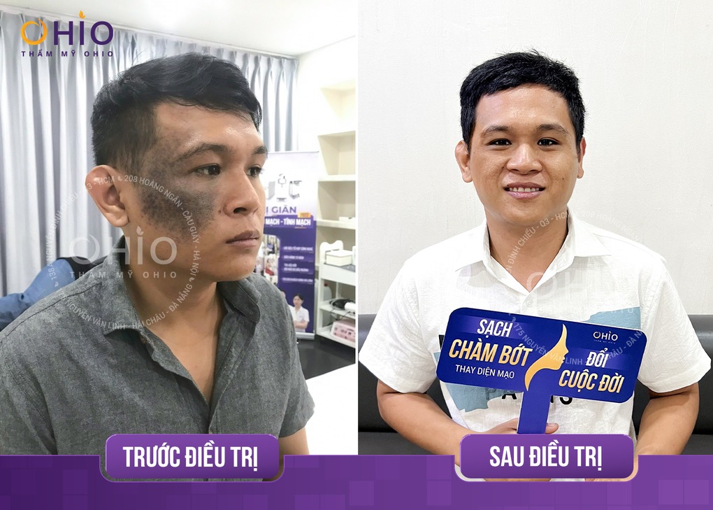 Xóa chàm bớt sắc tố hiệu quả với tổ hợp công nghệ Laser Pico - Phòng khám da liễu OHIO xóa chàm bớt sắc tố 4